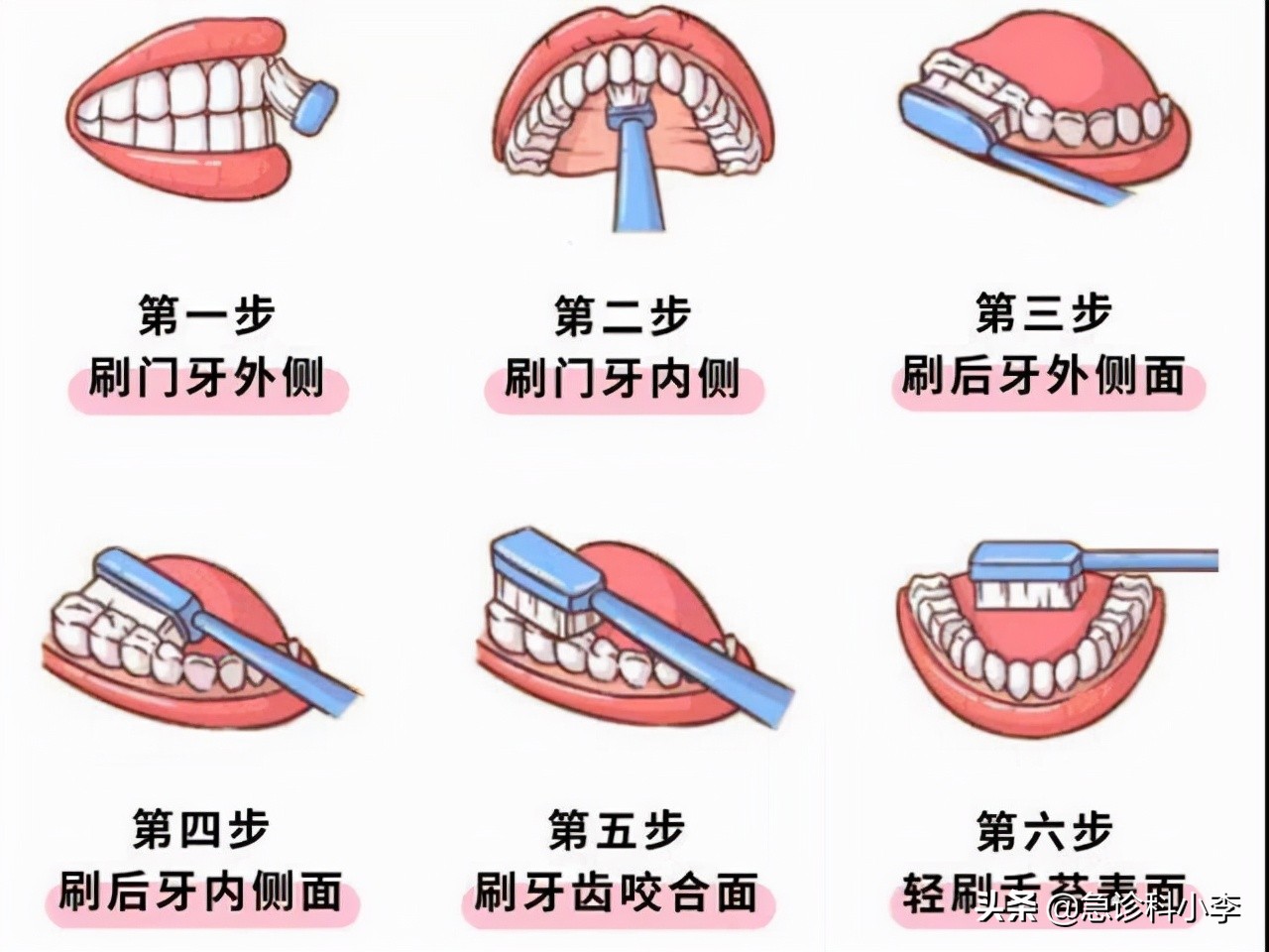 牙缝里的牙结石，如何清除干净？3个办法是不少人的选择